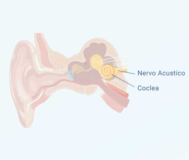 Illustrazione medica che mostra le componenti dell'orecchio interno associate all'ipoacusia neurosensoriale bilaterale, come il nervo acustico e la coclea