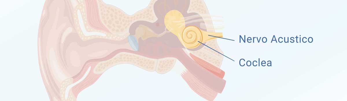 Illustrazione medica che mostra le componenti dell'orecchio interno associate all'ipoacusia neurosensoriale bilaterale, come il nervo acustico e la coclea
